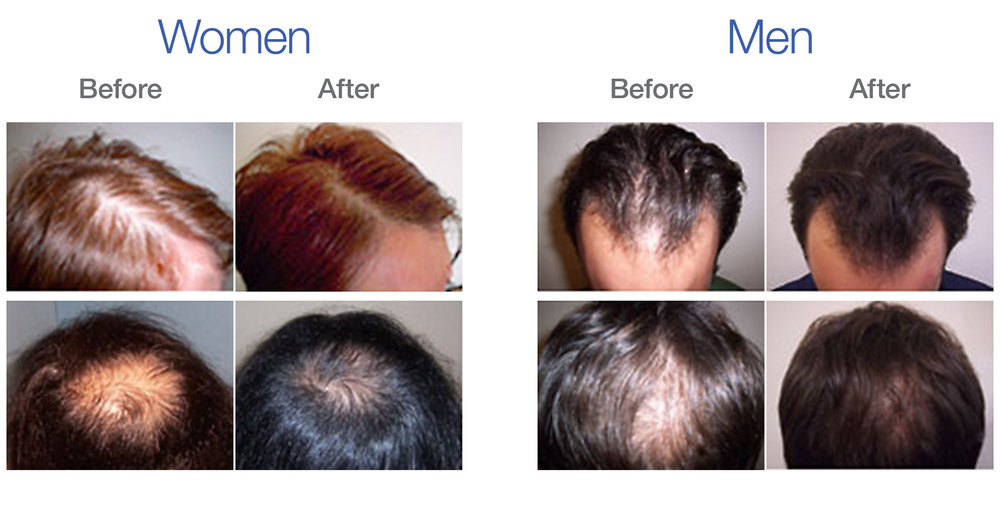 PRP Hair Regrowth Results in Female Patient · Bauman Medical