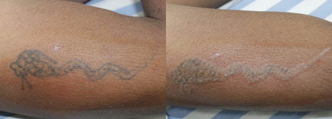 Elan Skin Care Clinic | Blog |removing-your-permanent-tattoo -easy-and-safe-way