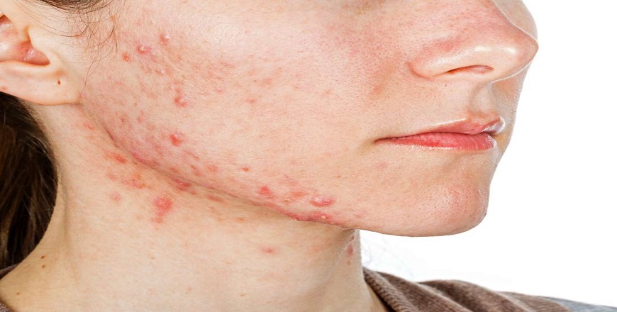 Acne and Acne scars